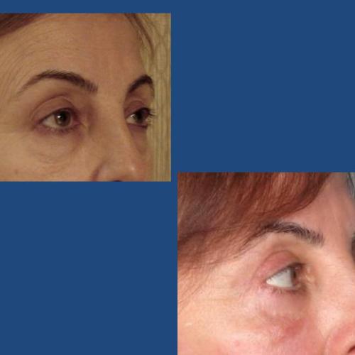 Blepharoplasty Before / After photo